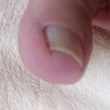 巻き爪の原因と治療、クリップやロボ、テーピングの応急処置