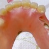 ノンクラスプデンチャーの欠点や寿命と入れ歯を作る時の注意点