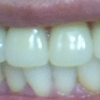 入れ歯の費用とノンクラスプデンチャーとスマイルデンチャーの違いや比較